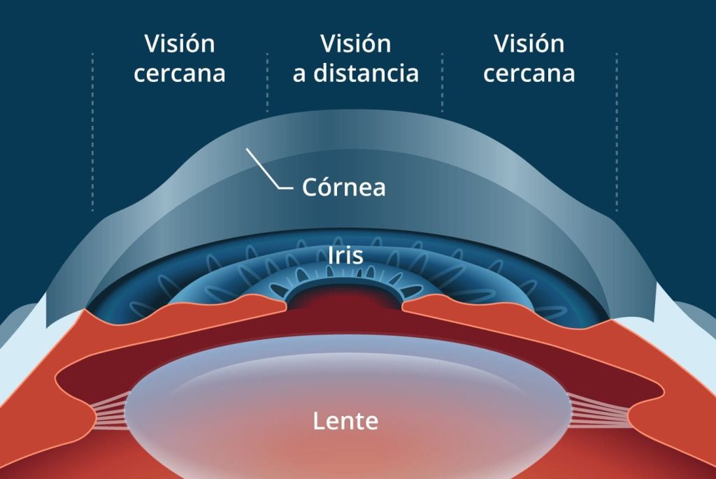 Presbylasik