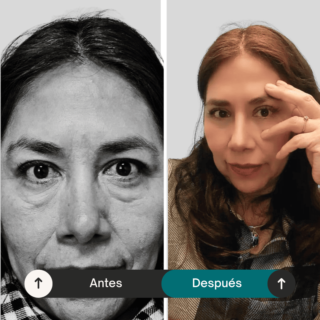 antes-y-después-operación-blefaroplastia