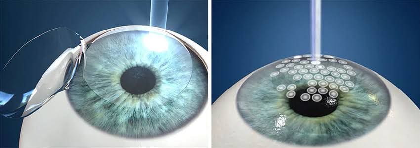 cirugía-lasik-de-ojo