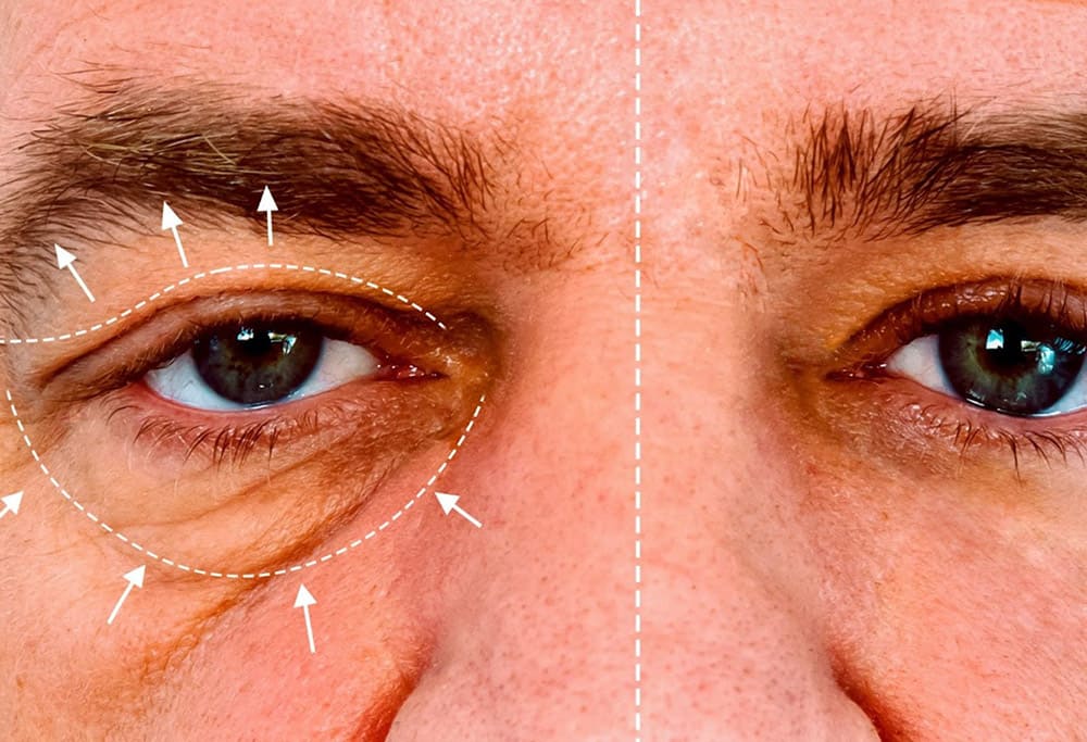 blefaroplastia-4-parpados