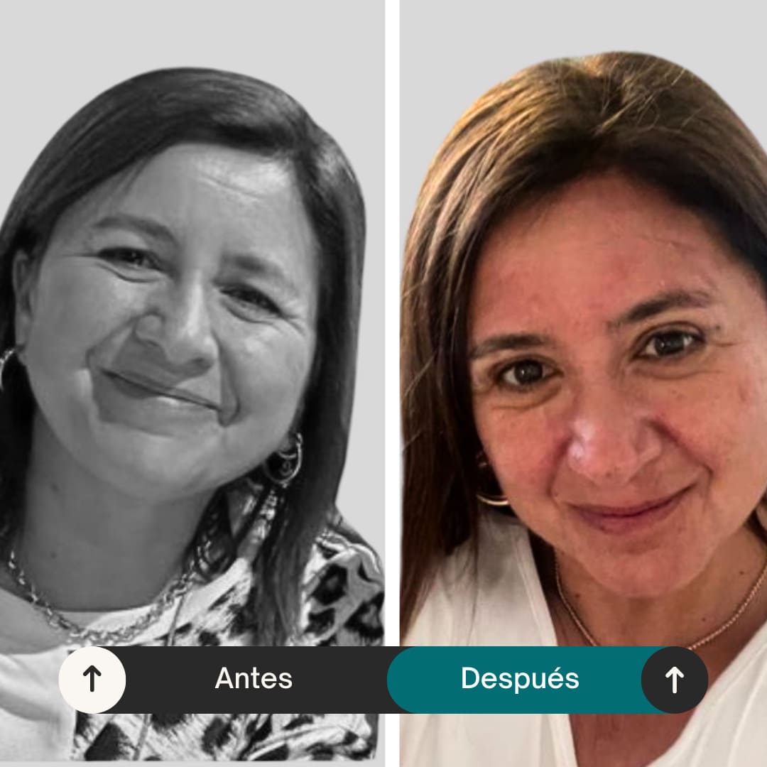 antes-después-cirugía-parpados-blefaroplastia
