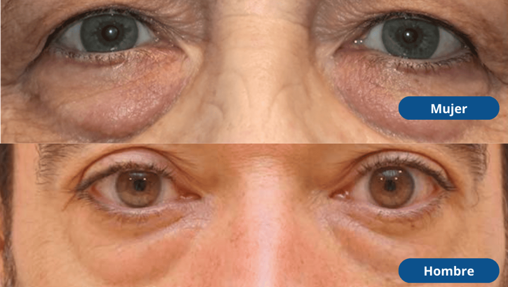 blefaroplastia-inferior