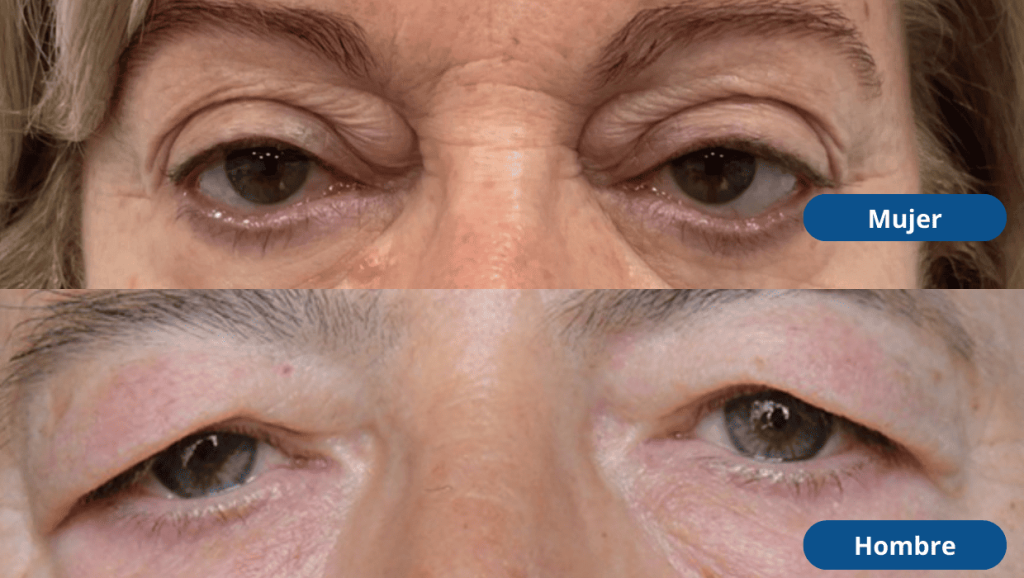 blefaroplastia-superior