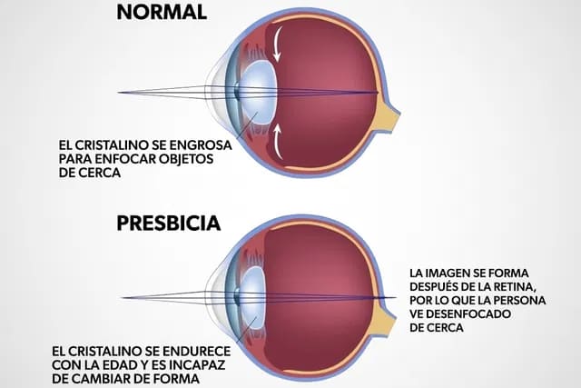 ojo-con-presbicia