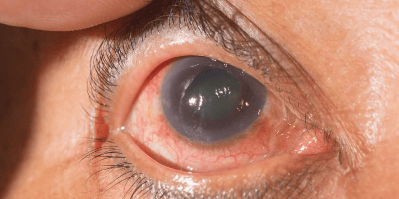 Glaucoma